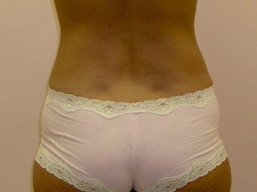 Tummy Tuck  Before & After Image