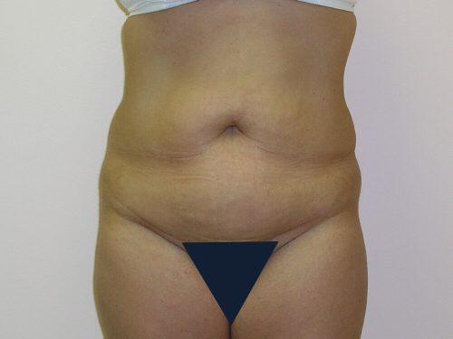 Tummy Tuck  Before & After Image