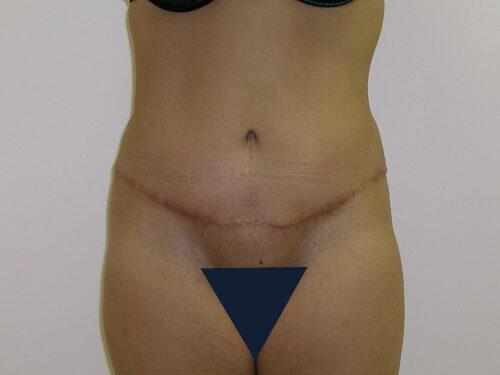 Tummy Tuck  Before & After Image