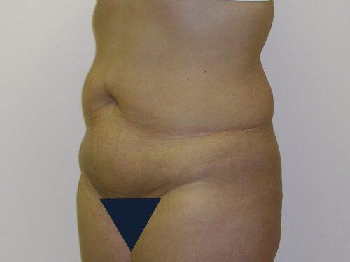 Tummy Tuck  Before & After Image