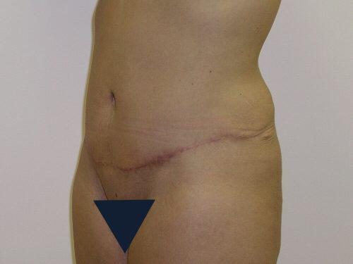 Tummy Tuck  Before & After Image