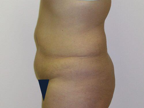 Tummy Tuck  Before & After Image