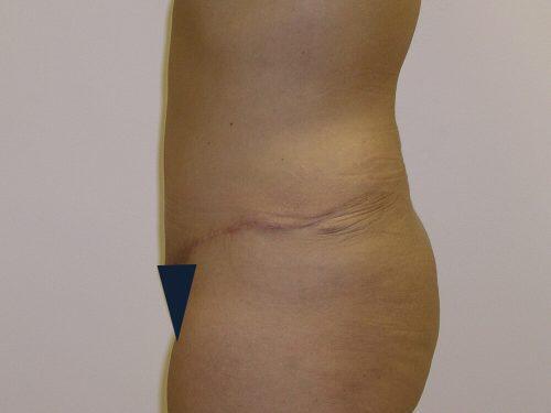 Tummy Tuck  Before & After Image