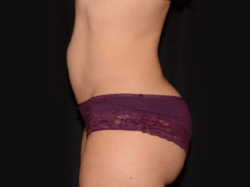 Tummy Tuck  Before & After Image