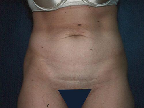 Tummy Tuck  Before & After Image