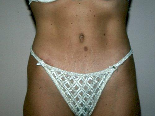 Tummy Tuck  Before & After Image