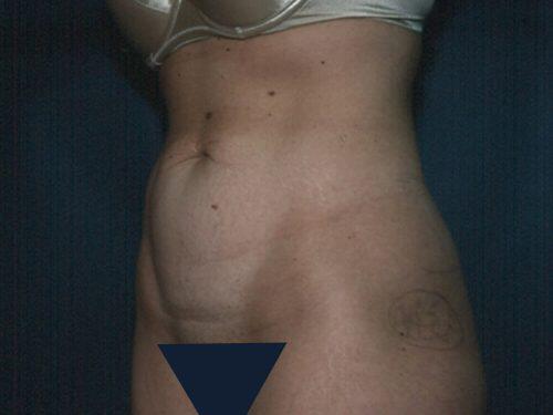 Tummy Tuck  Before & After Image