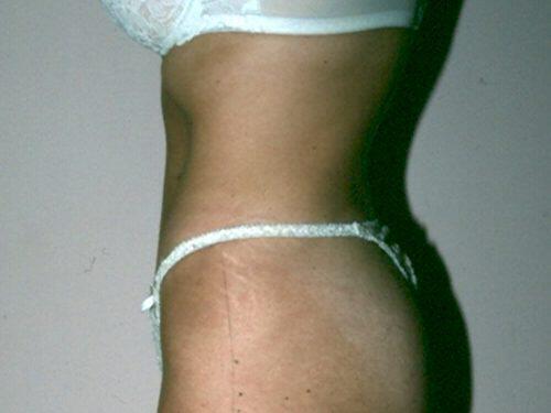 Tummy Tuck  Before & After Image