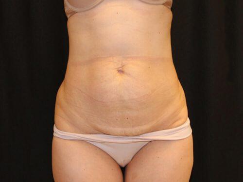 Tummy Tuck  Before & After Image