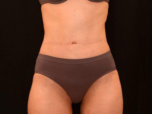 Tummy Tuck  Before & After Image