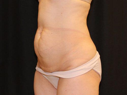 Tummy Tuck  Before & After Image