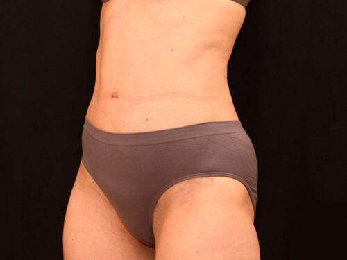 Tummy Tuck  Before & After Image