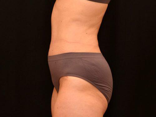 Tummy Tuck  Before & After Image