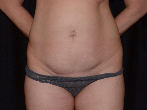 Tummy Tuck  Before & After Image