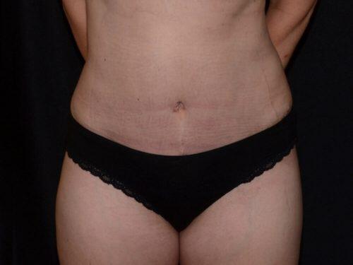 Tummy Tuck  Before & After Image