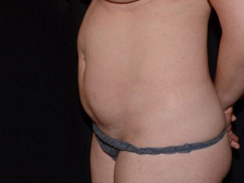 Tummy Tuck  Before & After Image