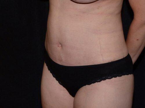 Tummy Tuck  Before & After Image