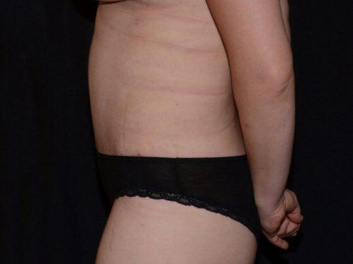 Tummy Tuck  Before & After Image