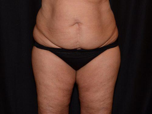 Tummy Tuck  Before & After Image