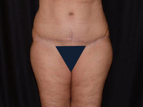 Tummy Tuck  Before & After Image