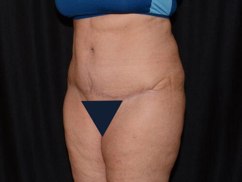 Tummy Tuck  Before & After Image