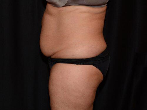 Tummy Tuck  Before & After Image