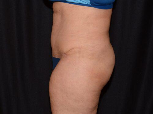 Tummy Tuck  Before & After Image