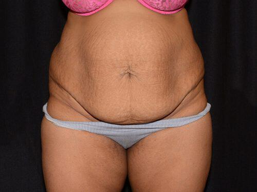 Tummy Tuck  Before & After Image