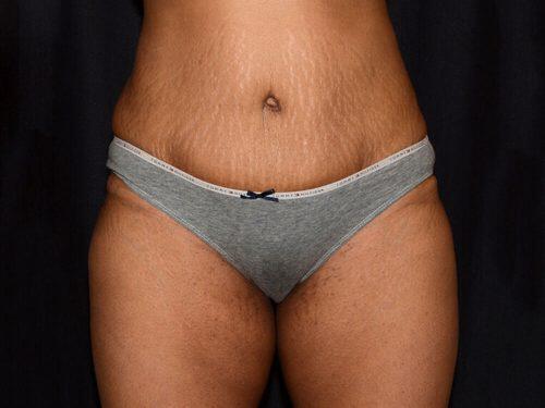 Tummy Tuck  Before & After Image