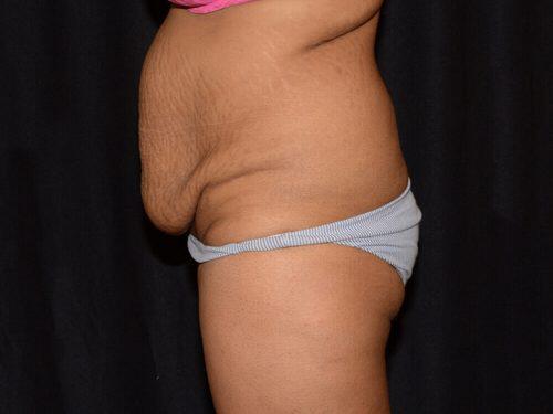 Tummy Tuck  Before & After Image