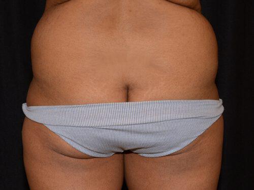 Tummy Tuck  Before & After Image