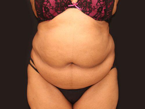 Tummy Tuck  Before & After Image