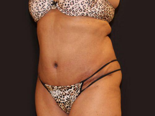 Tummy Tuck  Before & After Image