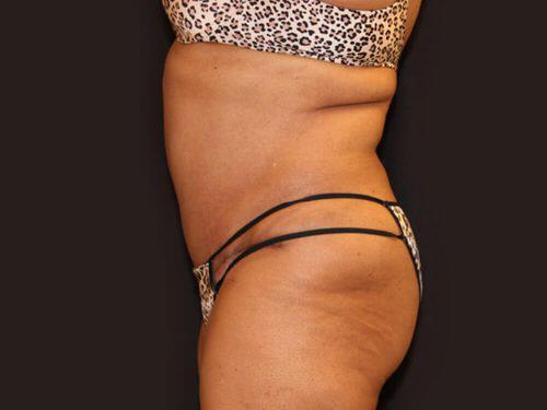 Tummy Tuck  Before & After Image