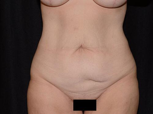 Tummy Tuck  Before & After Image