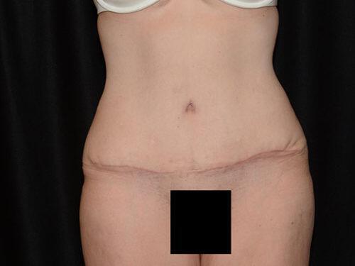 Tummy Tuck  Before & After Image