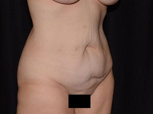 Tummy Tuck  Before & After Image