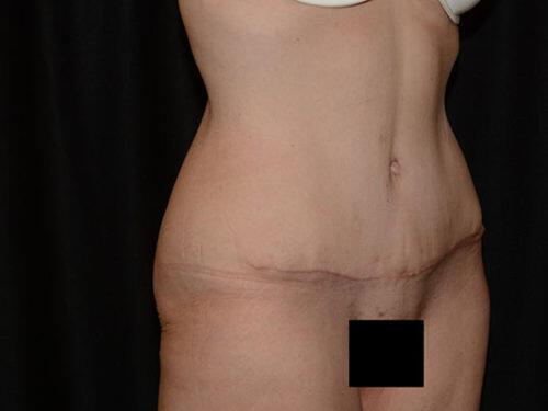 Tummy Tuck  Before & After Image