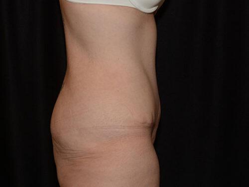 Tummy Tuck  Before & After Image