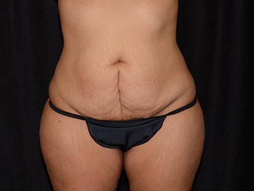 Tummy Tuck  Before & After Image