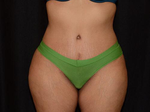 Tummy Tuck  Before & After Image