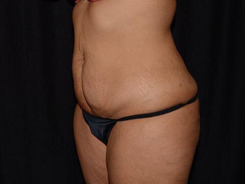 Tummy Tuck  Before & After Image