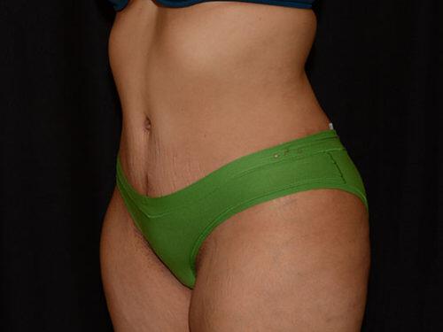 Tummy Tuck  Before & After Image