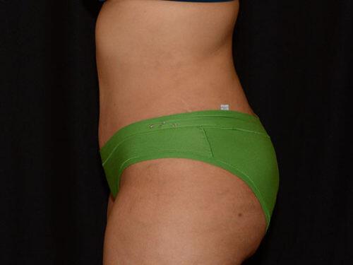 Tummy Tuck  Before & After Image