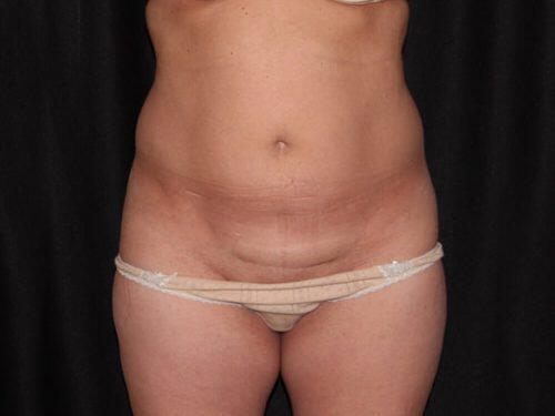 Tummy Tuck  Before & After Image