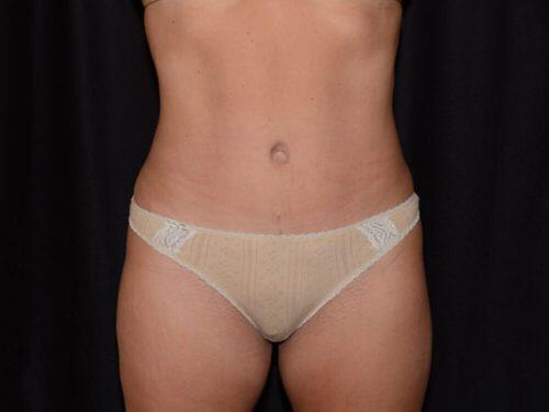 Tummy Tuck  Before & After Image