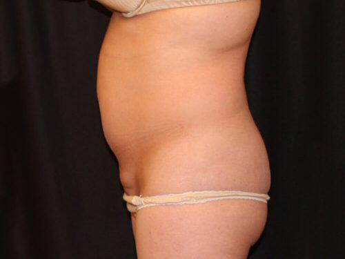 Tummy Tuck  Before & After Image