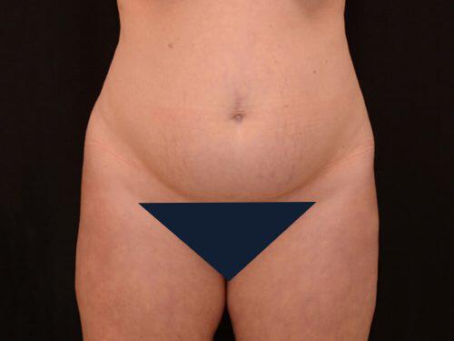 Tummy Tuck  Before & After Image