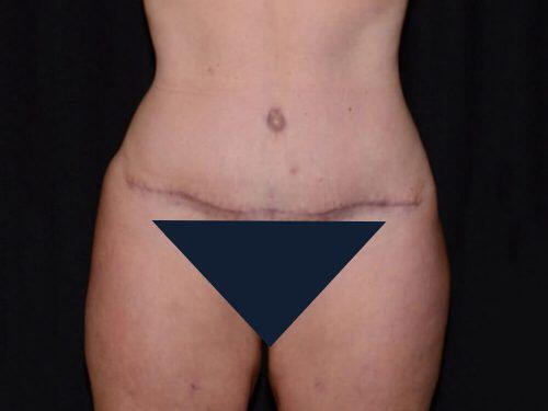 Tummy Tuck  Before & After Image