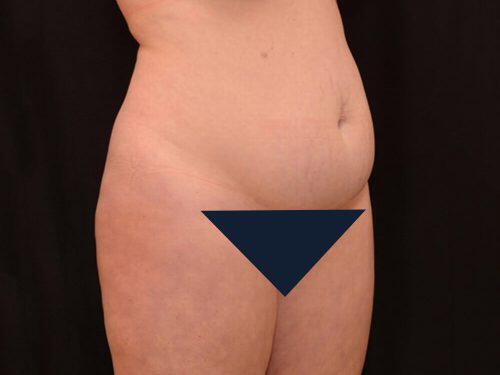 Tummy Tuck  Before & After Image